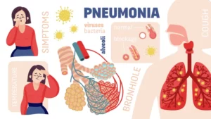 Gejala Mycoplasma pneumoniae dan Pneumonia Tipikal